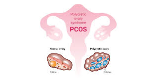 Understanding PCOS: Symptoms and Treatment